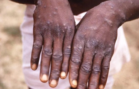 Lagos confirms two cases of Monkey Pox